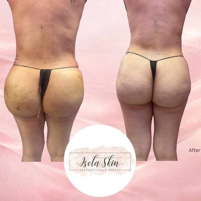 6 Post-Op Care Package at Isela Skin Aesthetically Pretty in Houston, TX
